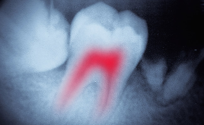 Tooth pain emphasized with x-ray