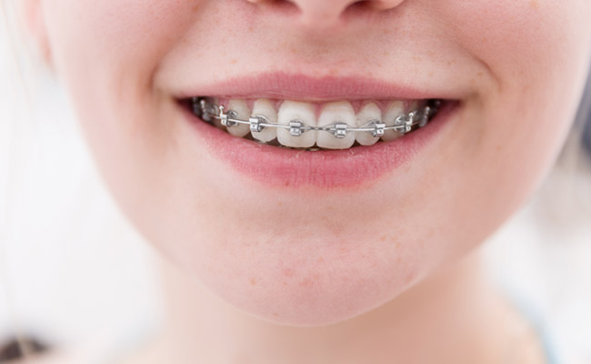 Young person smiling with metal braces