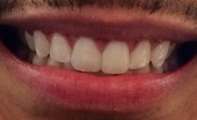 Real patient after composite bonding