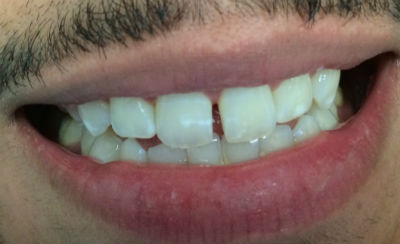 Real patient composite bonding before photo