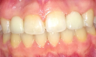 Real patient crown and bridge after photo