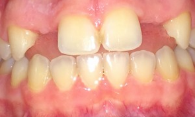 Crown and bridge real patient before photo