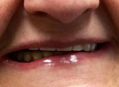 Real patient before denture procedure