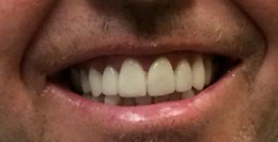 Real patient smile makeover procedure after photo