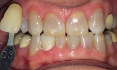 Real patient before teeth whitening