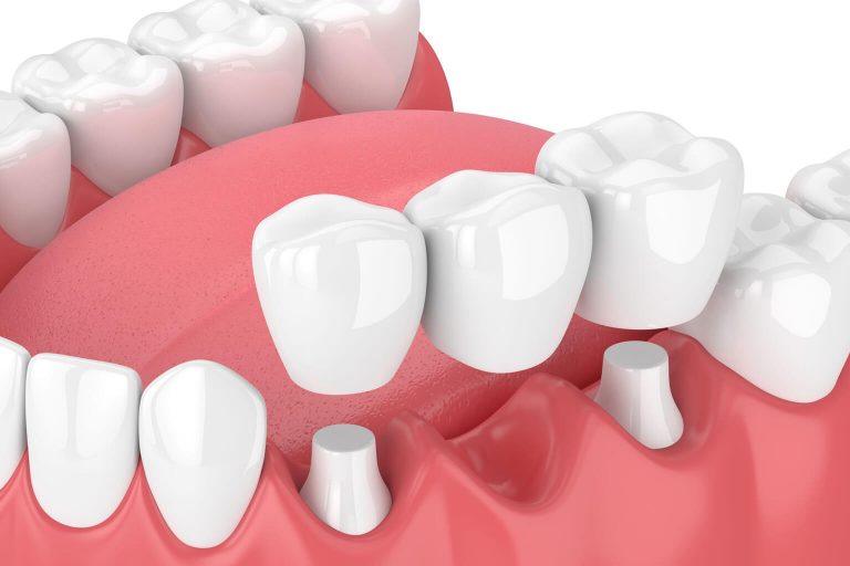 Illustration showing how a dental bridge is set.