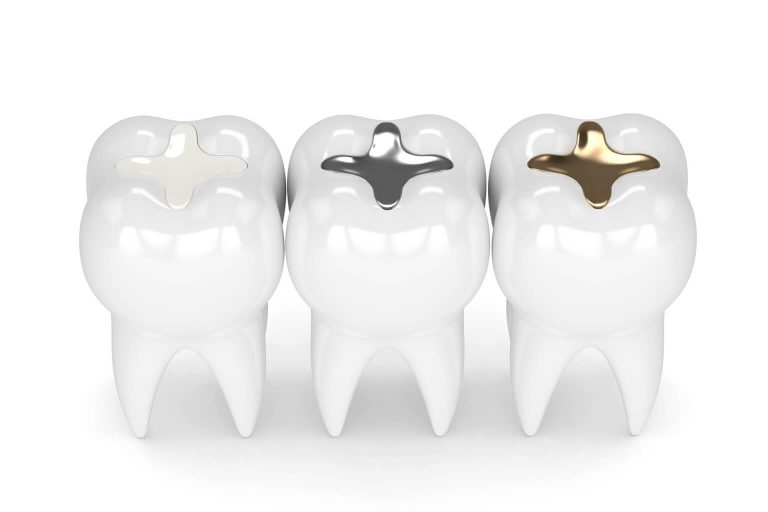 Illustration showing different dental filling types: Composite, Silver amalgam, and Gold.