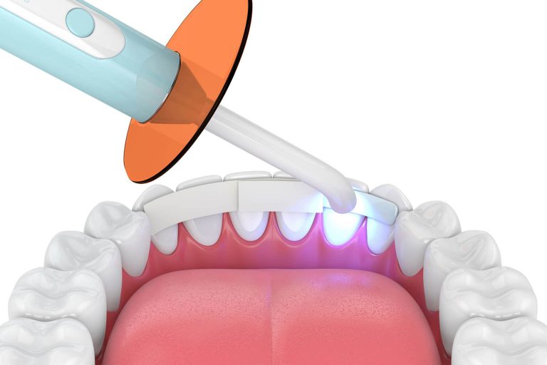 Illustration showing Dental Bonding being applied.