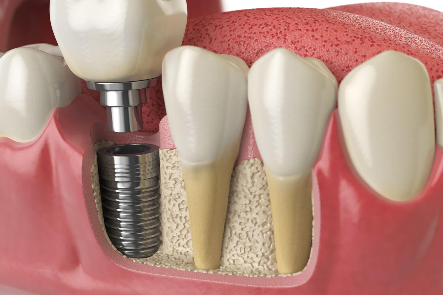 What is Bone Grafting