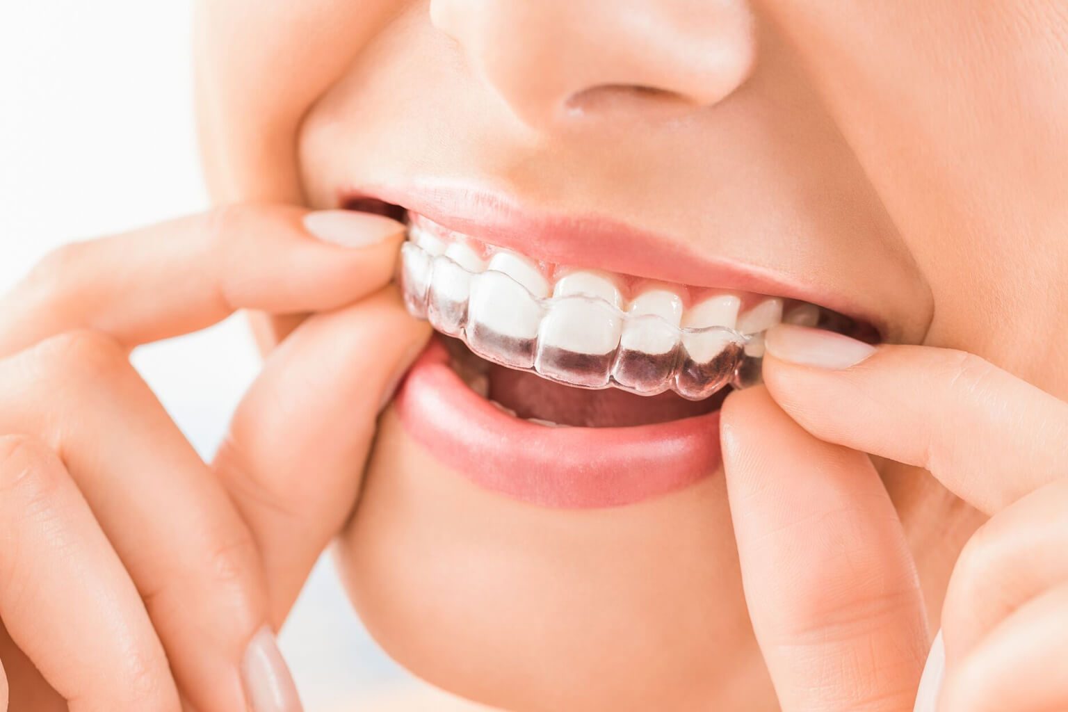 Close up photo of a woman wearing Invisalign clear braces.