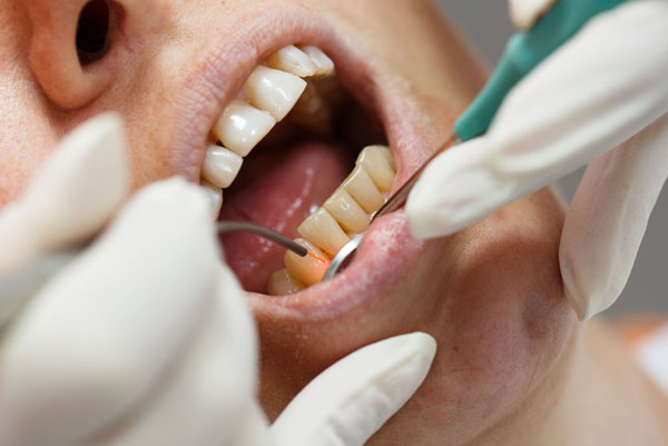 Closeup of dentist using laser dentistry to treat teeth and gums.