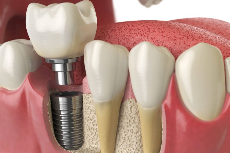 Illustration showing a dental implant.
