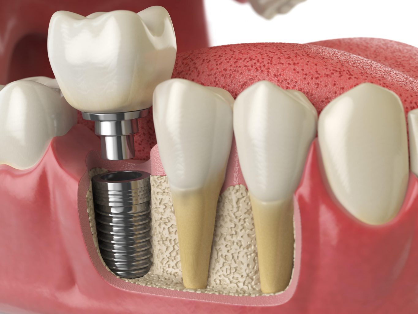 Diagram showing dental implants with titanium posts.