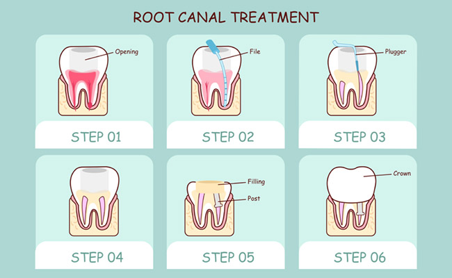 Root canal diagram showing procedural steps.