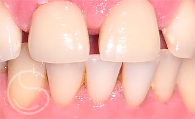 After photo dental emergency showing tooth repaired with filling.