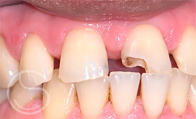 Before photo dental emergency showing broken tooth.