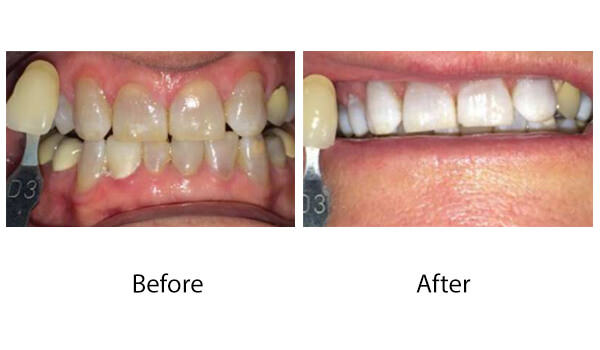 Before and after photo of teeth whitening