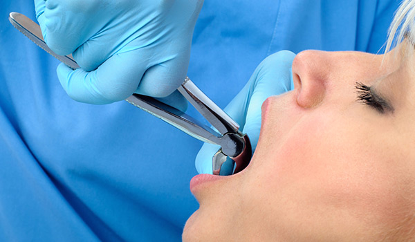Dentist performing a tooth extraction
