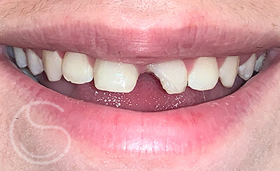 Dental emergency before photo with broken front tooth.