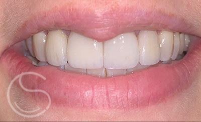 Smile makeover after photo