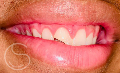 Sports injury - before photo of a dental emergency to fix a broken tooth