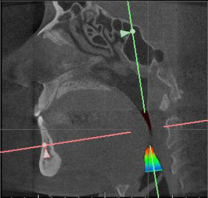 Sleep Apnea - x-ray showing severe obstruction