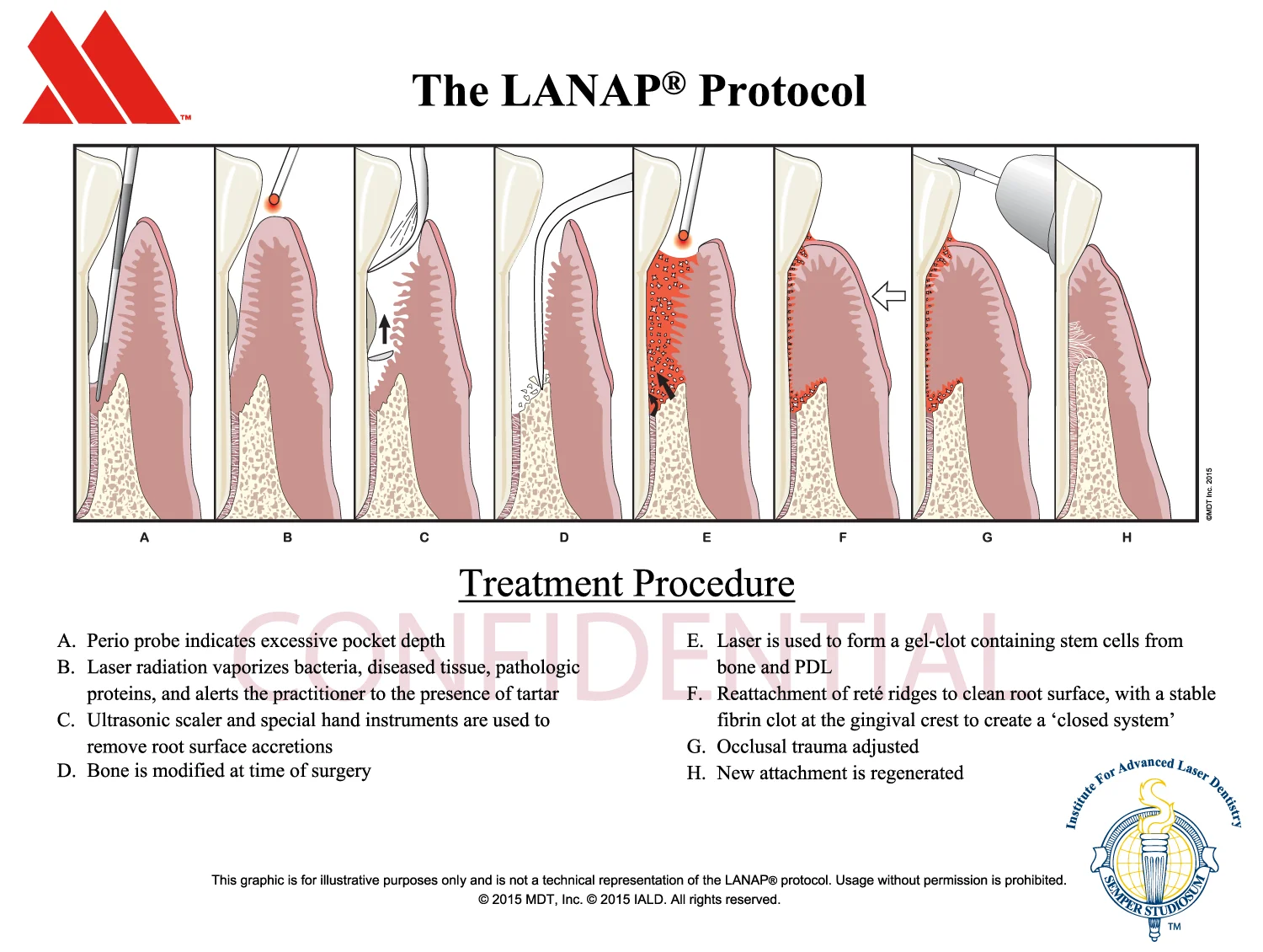 LANAP illustration showing different steps of this procedure with brief description