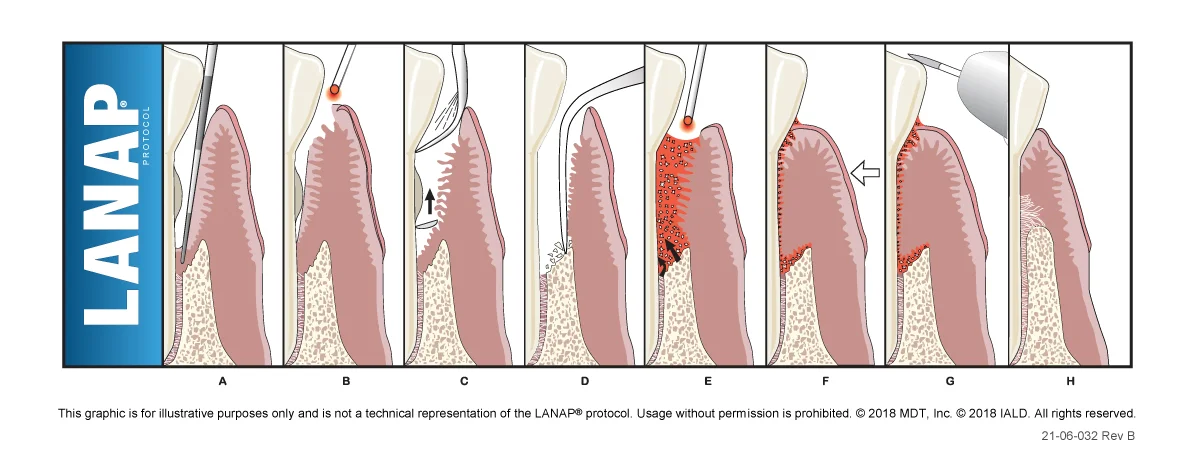 LANAP illustration showing different steps of this procedure