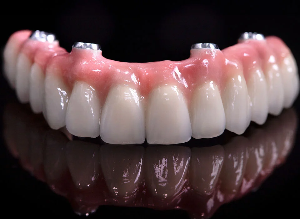 advances-in-dental-implants