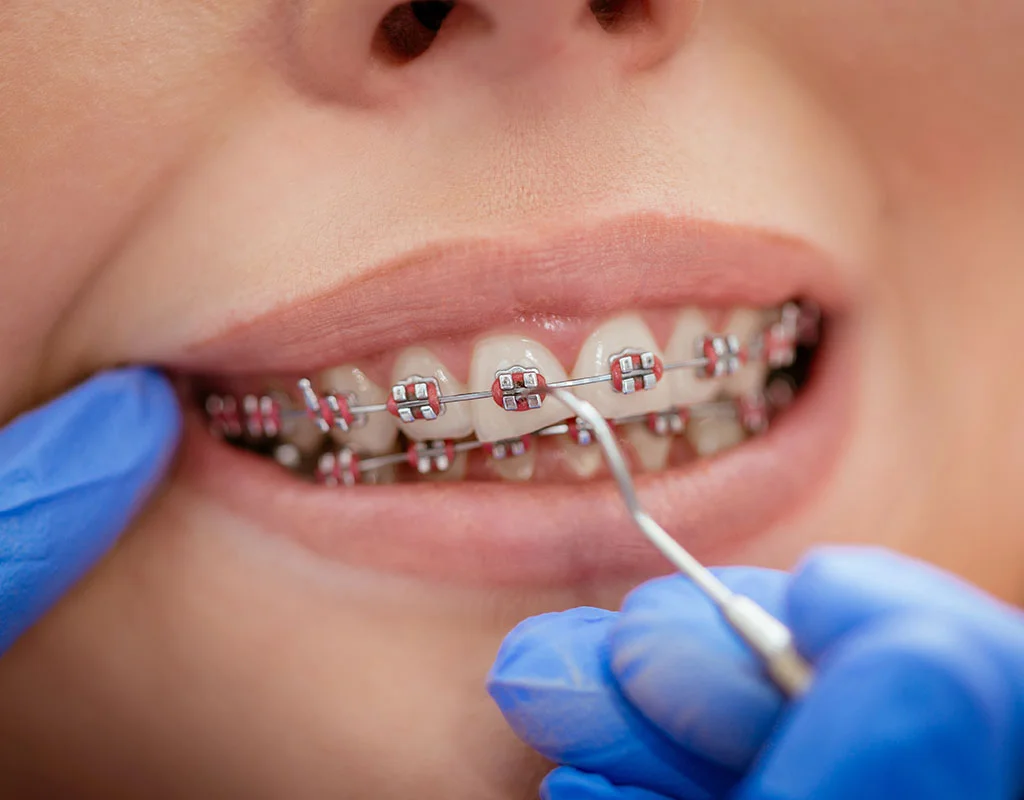 closeup-braces