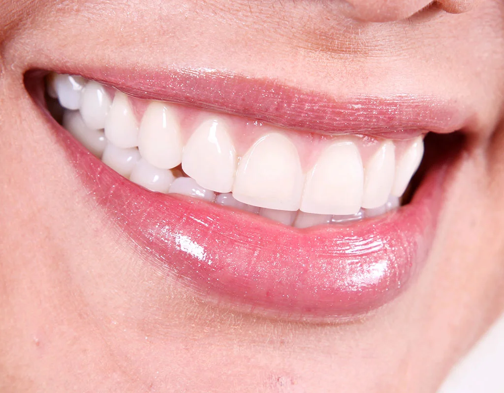 teeth-whitening-closeup